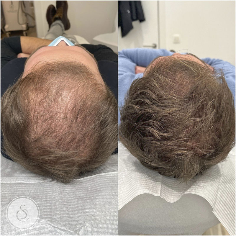 haaruitval orthomoleculair