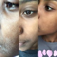 shea butter droge huid